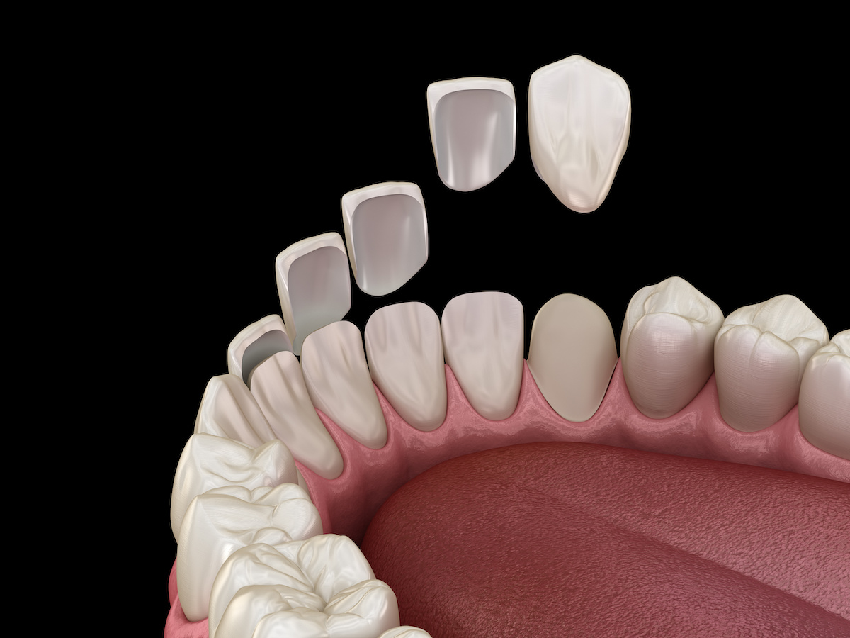 Learn about how the dental veneers work