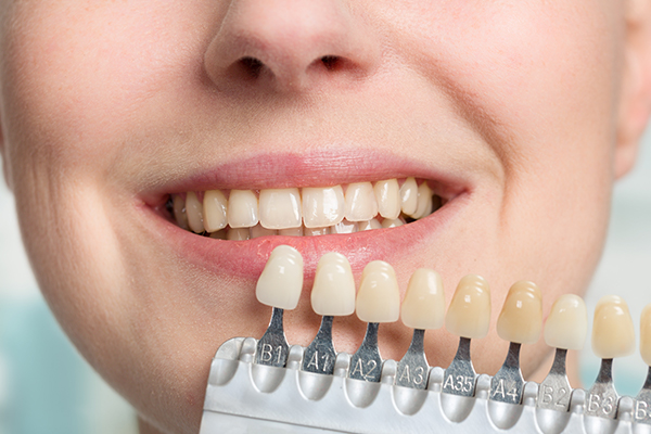 We will be based on your teeth and provide the natural veneers