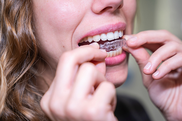 The cost of Invisalign can vary from different factors