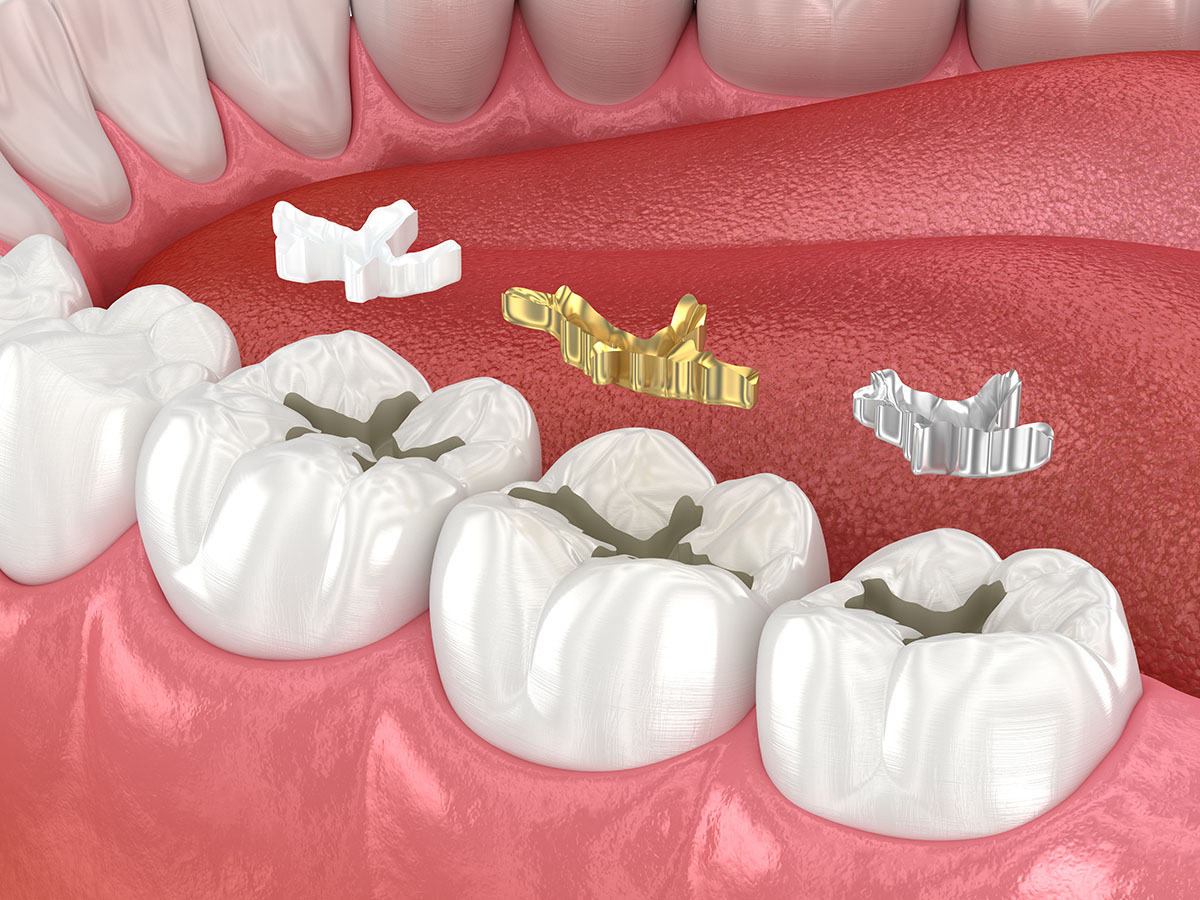 Dental fillings illustration: ceramic, golden, metal